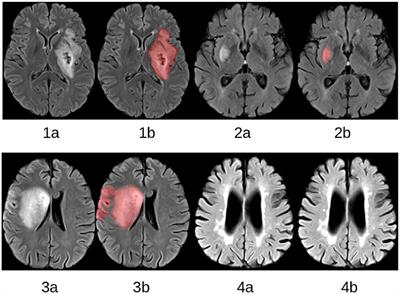 Stroke Lesion Segmentation in FLAIR MRI Datasets Using Customized Markov Random Fields